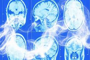 یک مطالعه جدید هشدار می دهد که سیگار کشیدن مغز انسان را کوچک می کند و هنگامی که توده مغزی از بین رفت، برای همیشه از بین 