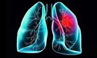 ۹۰ درصد مبتلایان به سرطان ریه، سیگاری هستند
