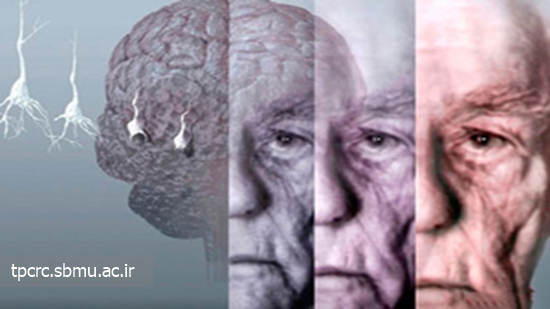 آلزايمر-سيگار، 