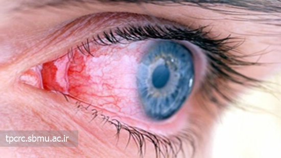 آسيب-سيگار-به-بينايي، 