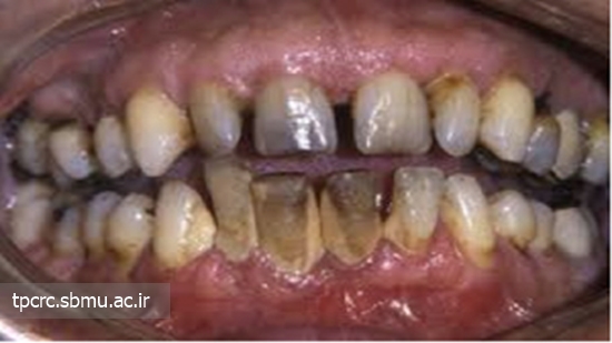 قلیان باعث افزایش پوسیدگی دندان می‌شود 