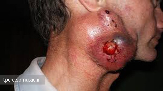 سيگار و سرطان سر و گردن، 