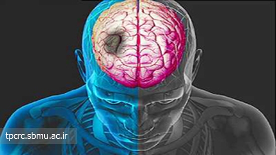 قليان و سكته مغزي، 