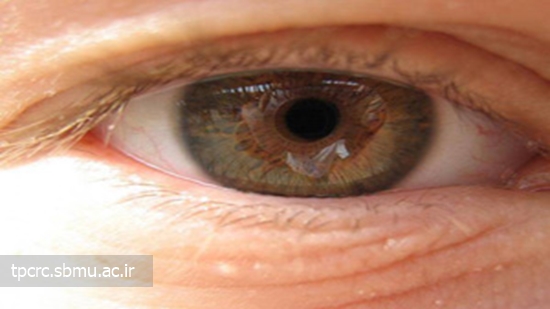 سيگار و بيماري چشمي، 