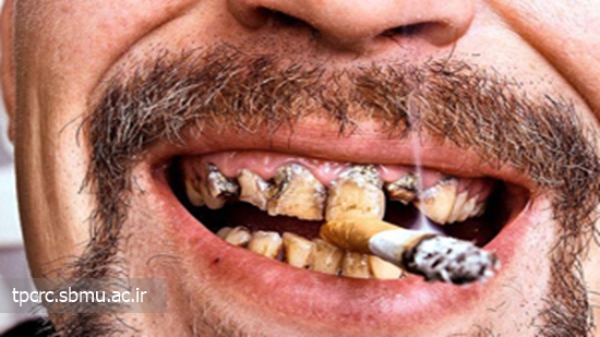 سيگار و سرطان دهان، 
