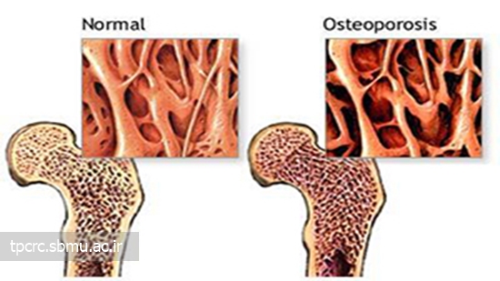 سیگار و پوکی استخوان، 