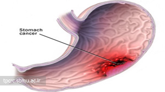 سيگار و زخم معده، 