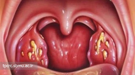 مصرف سیگار مهمترین عامل ابتلا به سرطان لوزه، 