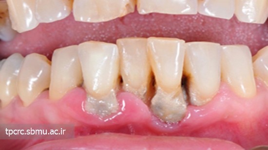 سيگار و ضعف ايمني دندان، 