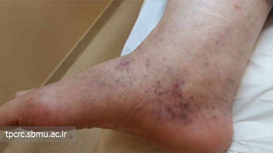 مصرف سيگار و واريس، 